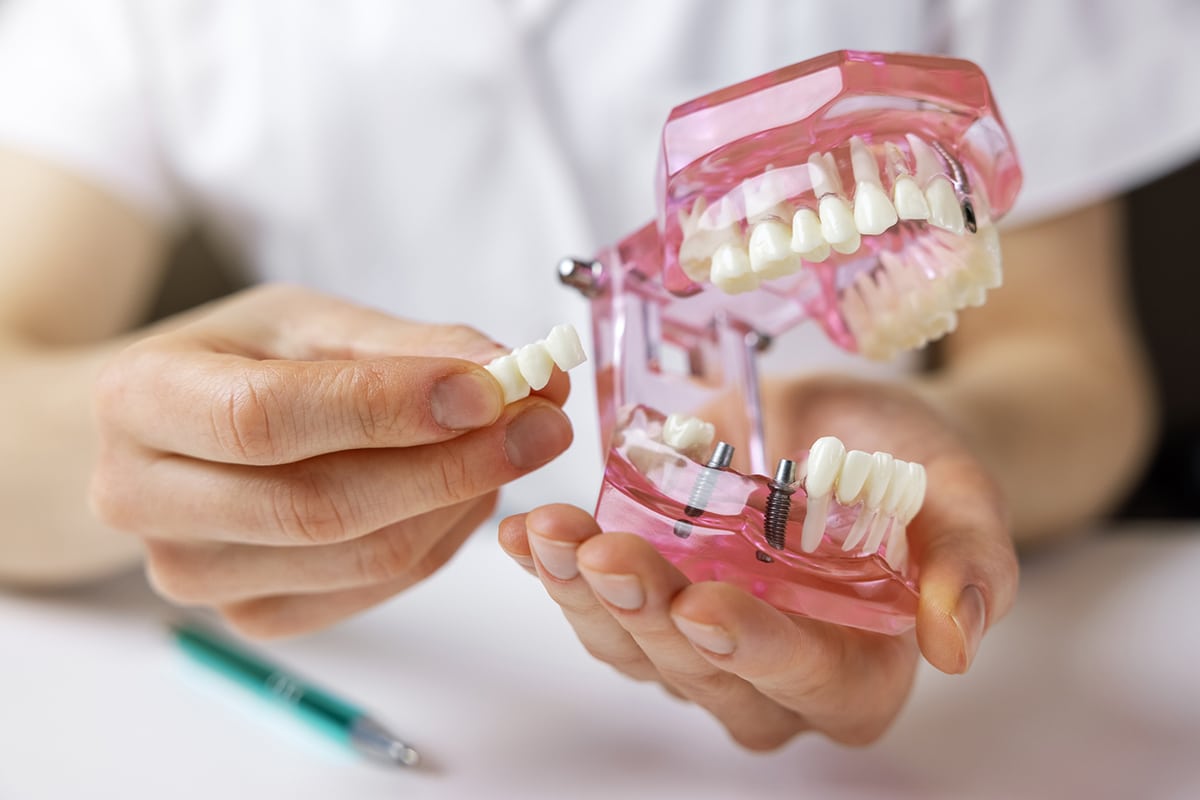 How much do dental implants cost in milledgeville ga blog